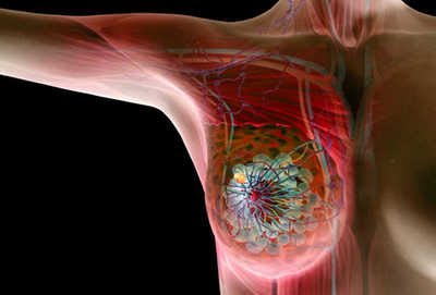 Breast Cancer-Dr-Qaisar-Ahmed-Dixe-cosmetics
