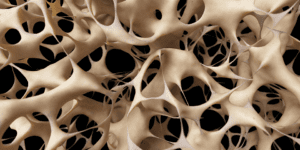Osteoporosis in Postmenopaus