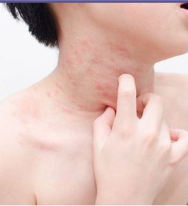 Itchy Bumps or folliculicitis-Causes-Diagnosis-Top Homeopathic doctor in Pakistan-Dr Qaisar Ahmed-Al Haytham clinic-Risalpur