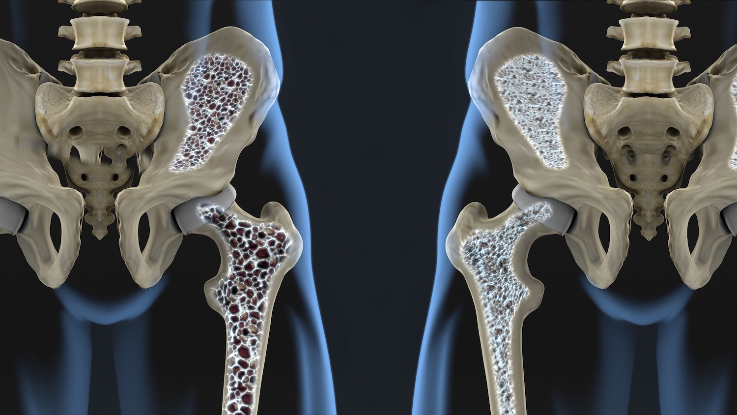 Osteoporosis in Postmenopaus