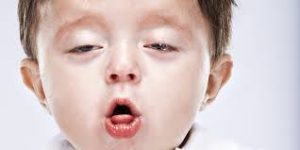 whooping-Cough-Historical Infectious Disease-Causes-Best Treatment-Homeopathic best doctor in Pakistan-Dr Qaisar Ahmed-Al Haytham clinic-Risalpur