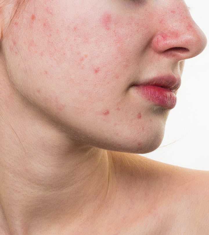 Tiny Red Spots On Skin Petechiae By Dr Qaisar Ahmed Dixecosmetics 