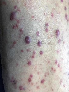 Petechiae - Tiny Red Spots on Skin - causes - diagnosis - Treatment - Homeopathic - Dr - Qaisar - Ahmed - Dixe - Cosmetics