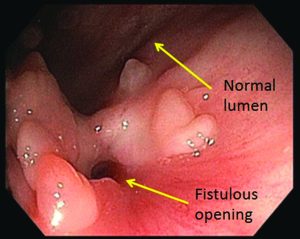 Vesicocolic - Fistula - Foamy Urine or Bubbles in Urine _ Types _ Causes _ Symptoms _ Diagnosis - Treatment _ Dr - Qaisar _ Ahmed - Dixe _ Cosmetics