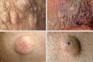 cysts-on-inner-thigh-dr-Qaisar-Ahmed-Dixe-cosmetics