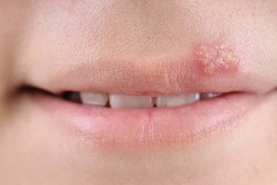 herpes-zoster-Dr-Qaisar-Ahmed-Dixe-cosmetics