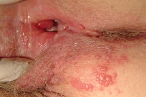 herpes-zoster-female-Dr-Qaisar-Ahmed-Dixe-cosmetics