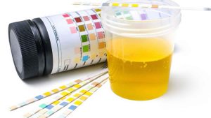 proteinuria - Foamy Urine or Bubbles in Urine _ Types _ Causes _ Symptoms _ Diagnosis - Treatment _ Dr - Qaisar _ Ahmed - Dixe _ Cosmetics