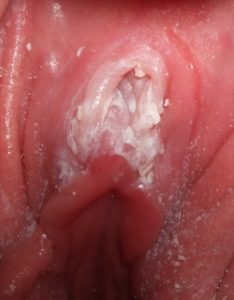 Vaginal - candidiasis - Yeast infection _ Types _ Symptoms _ Treatment _ Dr - Qaisar _ Ahmed - Dixe _ Cosmetics