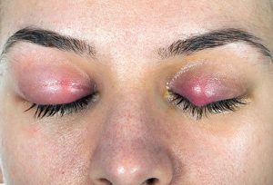 Blepharitis - Eyelid - Inflammation - Dr - Qaisar - Ahmed - dixe - cosmetics