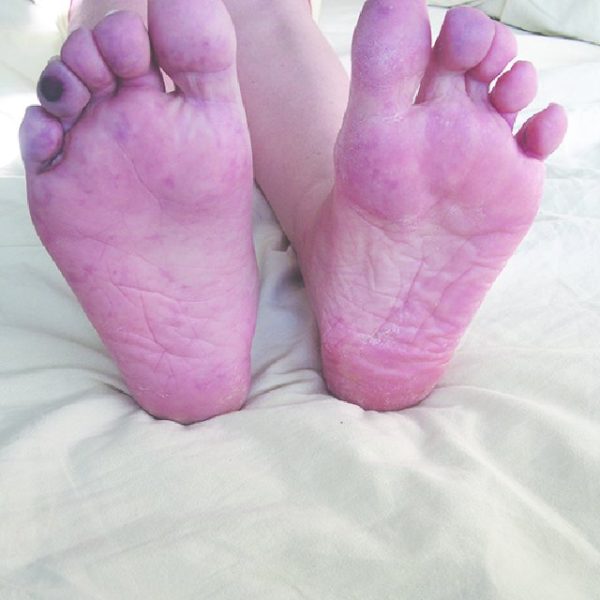 Blue Toe Syndrome By Dr Qaisar Ahmed Md Dhms Isl Jurisp