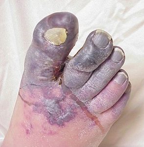 Blue - Toe - Syndrome - dixe - cosmetics - dr - qaisar - ahmed