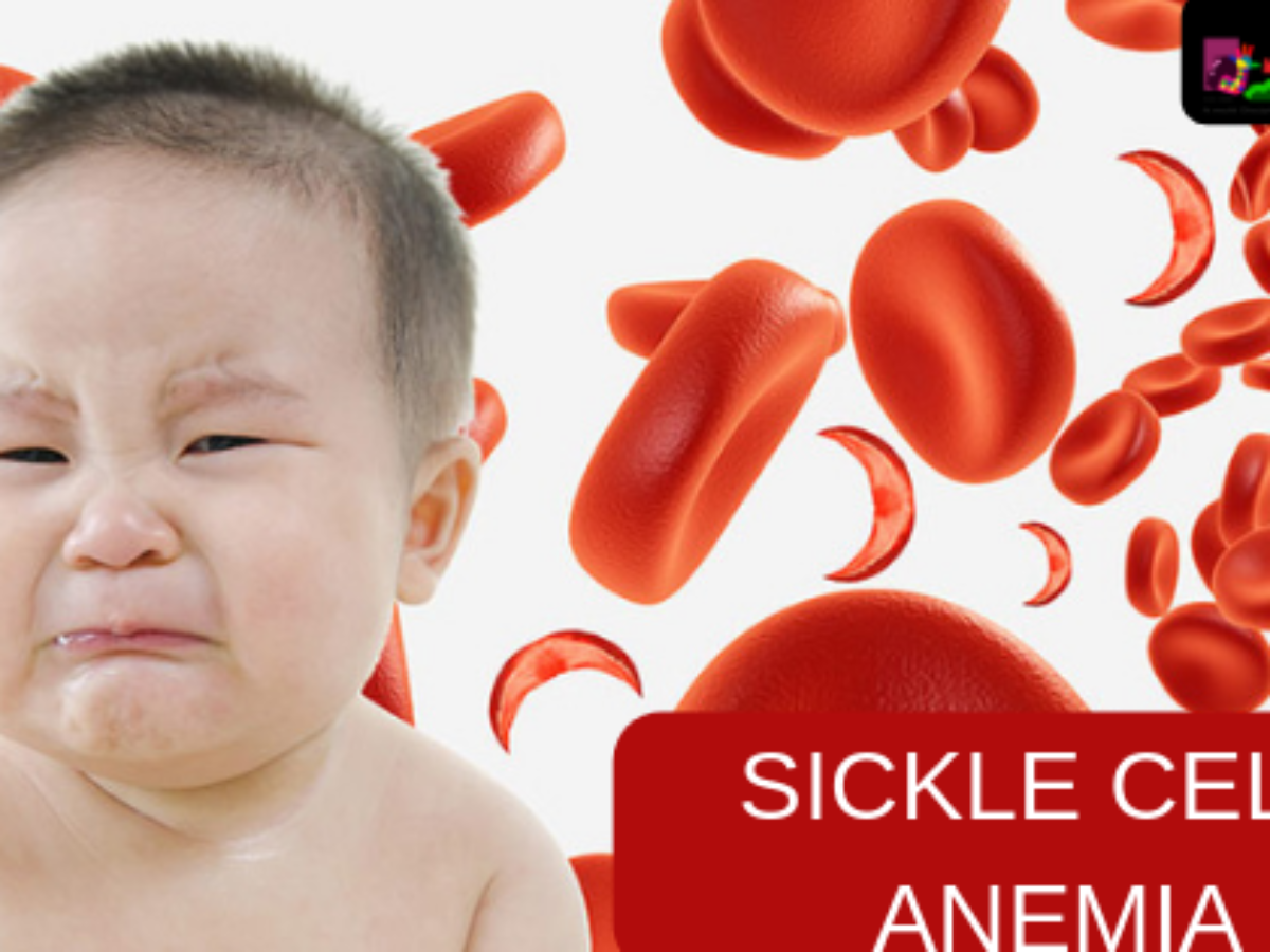 SICKLE-CELL-ANEMIA - Causes - Diagnosis - Treatment - Best Homeopathic doctor pakistan - Dr Qaisar - Ahmed - Dixe - cosmetics